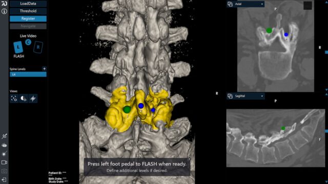 Vertibral Level Identification Spine Image